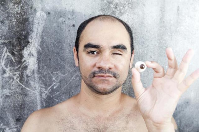 攝影師Sérgio Andrade da Silva在2013年6月13日於聖保羅市的一場抗議活動中,被憲兵以橡皮子彈擊中,而失去一隻眼睛。© Sérgio Andrade da Silva